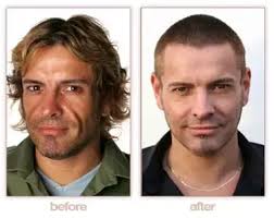 Hyaluronic acid fillers, like restylane, juvederm, voluma have been use for more than 20 year to augment soft tissue. I M A 17 Year Old With Nasolabial Folds What Can I Do About Them Quora