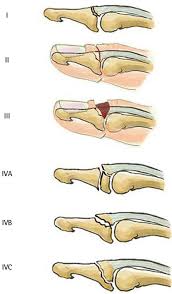 With mallet finger, the tendon on the back of the finger (not the palm side) is separated from the muscles it connects. Mallet Finger Hand Orthobullets