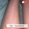 Also known as depilatory creams, these powerful products can effectively remove unwanted hair in general, hair removal creams are considered safe. 1