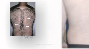 Waxing, plucking, and shaving are all painful endeavors and you have to do them again if a few days, or at best, a few weeks. Ipl Hair Reduction Monmouth County Laser Hair Removal Wall