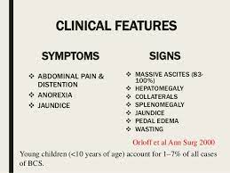 Budd Chiari Syndrome Ppt
