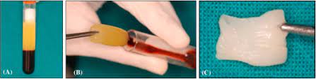 Prf box® is used to create prf membranes. Platelet Rich Fibrin An Overview Sciencedirect Topics