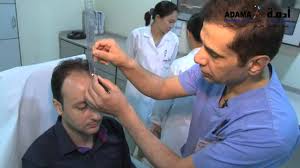 التفاصيل الكاملة لزراعة الشعر بتقنية الإقتطاف د احمد التركي مستشفى وعيادات أدمة Youtube
