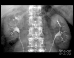Image result for Intravenous Pyelogram