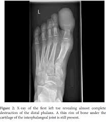 Primary bone cancer is rare, making up around 0.2 percent of all cancers, according to the american society of clinical oncology. Aneurysmal Bone Cyst In A Phalanx Of A Toe Omics International
