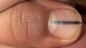 Haben Sie Diesen Streifen Auf Dem Fingernagel Ist Es Gefahrlich Gesundheit
