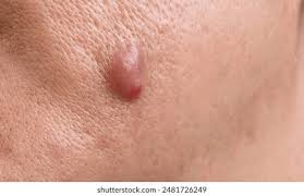 Image result for Nodule