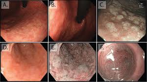 Types of stomach polyps and their causes and treatments are discussed. Recent Advances In The Detection And Management Of Early Gastric Cancer And Its Precursors Frontline Gastroenterology