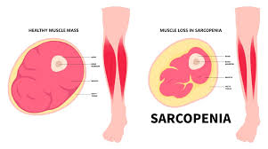 How to Prevent Sarcopenia and Muscle Loss