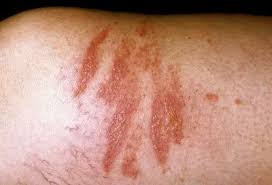 Image result for Photodermatitis