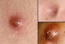 Fata, gat, axile, pe partea interioara a coapselor, pe abdomen, pe fese. Furuncul Cum Il TratÄm AcasÄ Cu Remedii Naturale Alecia Ro