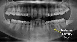 Retained Primary Teeth Your Smile Dental Care