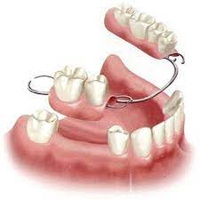 Partial Dentures A Viable Alternative To Dental Implants Need A Dental Clinic We Offer Reliable Compreh Dental Implants Partial Dentures Tooth Implant Cost