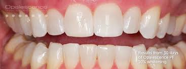 Maybe you would like to learn more about one of these? Opalescence Teeth Whitening