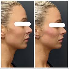 ✨Revision Revox Line Relaxer✨ The photo