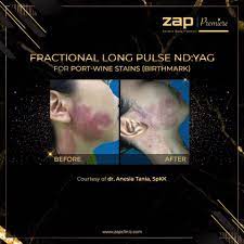 Tanda lahir salmon patch termasuk jenis tanda lahir yang disebabkan oleh pembuluh darah di kulit yang berlebihan. Zap Clinic Tanda Lahir Bisa Di Mana Saja Mulai Dari Facebook