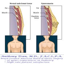 Buy male chest muscle of all types on awesome deals. Male Breast Reduction Arlington Gynecomastia Tx
