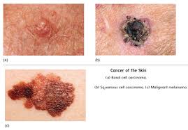 Skin cancer known as melanoma associated with _____? Skin Cancer