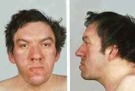 What is adenohypophysis?