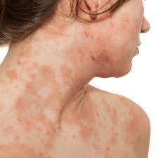 Check spelling or type a new query. 18 Common Skin Rash Pictures How To Id Skin Rash Symptoms