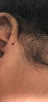 Check spelling or type a new query. Holes On Top Of Babies Ears Hot Topics Forums What To Expect