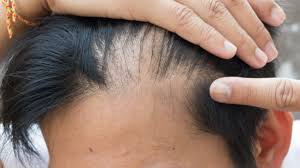 Further, the appearance of the scar may prevent hair transplant patients from wearing short hairstyles, such as crew cuts. I Have An Itchy Scalp Do I Have Scalp Psoriasis Orlando Fl Dr Jeannette Hudgens