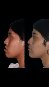 Cirugía Ortognática en paciente Clase III con Asimetría , 👉🏼Les comparto  un nuevo caso de antes y después de nuestra querida paciente la cual  presentaba una Clase III Esqueletal por un prognatismo ...