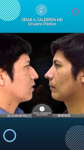 Cesar Calderon MD, Cirujano Plastico