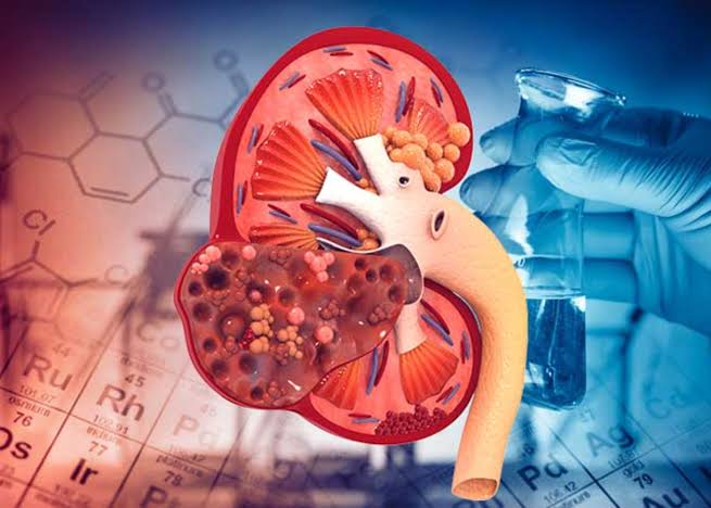 5 dấu hiệu suy thận sớm thường bị nhầm là do mệt mỏi, tuổi tác, người Việt  nên biết để phòng bệnh
