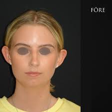 22 årig tjej före och 7 mån efter öppen näsplastik.