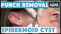 Cyst Pocket Removal