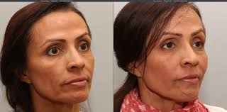 But in that short time, you will learn how to use the very common english expression how. Sculptra Aesthetic Torrance Ca Lumier Medical