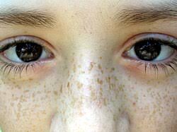 Image result for Freckled skin