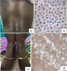 Image result for Diffuse Hyperpigmentation