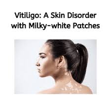 The most common symptom of vitiligo is light or depigmented spots on the skin. Vitiligo A Skin Disorder With Milky White Patches Niruja Healthtech