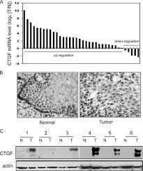 If you think using tanning beds as an alternative to sun tanning will protect you from scc, think again. Connective Tissue Growth Factor Is Overexpressed In Esophageal Squamous Cell Carcinoma And Promotes Tumorigenicity Through B Catenin T Cell Factor Lef Signaling Journal Of Biological Chemistry