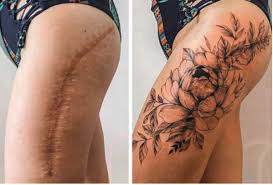 Anyone cover their scars with a tat? I'm considering doing bothering hips.  💕