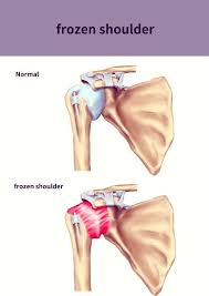 Image result for Frozen Shoulder