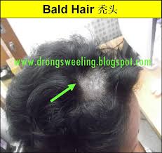 Female pattern hair loss is the commonest cause of hair loss in women and prevalence increases with advancing age. Tcm News Hair Loss Grew Well After Tcm Treatment For Hair Loss