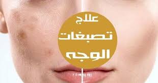 طريقة التخلص من التصبغات الجلدية في الوجه صحة البشرة واشراقتها من اهم الامور التي تراعي لها النساء لكن العديد يستعمل منتجات كيميائية لاصلاح هذه العيوب لكن هذ