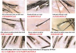 I don't know how else to describe them. Crystallized Sebum Balls In Hair Hardened Sebum On Scalp