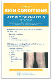Image result for Atopic eczema atopic dermatitis