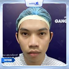 Bệnh viện thẩm mỹ Gangwhoo (@benhvienthammygangwhoo) · Instagram 照片和视频