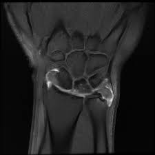 Bilyard masalarının istehsalında yalnız bir sıra təbii. Triangular Fibrocartilage Complex Injury Radiology Reference Article Radiopaedia Org