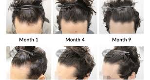 However, women and girls have low levels of testosterone as well. Is Hair Loss Near Cowlick Normal