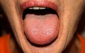 White fungus symptoms in hindi. After Black Fungus White Fungus Cases Reported In Bihar Amid Covid 19