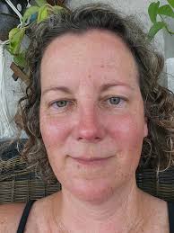 My eyes Burns a lot and it be dry and watery