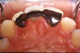 Seorang wanita berhadapan detik cemas apabila dia tertelan gigi palsu selama 72 jam. Maryland Bridge Denture Pro Kl
