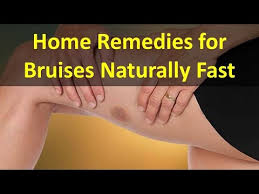 A group of enzymes found in the pineapple, may help make a bruise go away faster. How To Make A Bruise Go Away Fast Home Remedies For Bruises Youtube