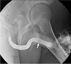 Image result for Retrograde Urethrogram